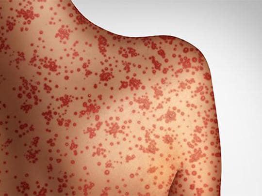 PAHO calls for regional action as the Americas lose measles elimination status
