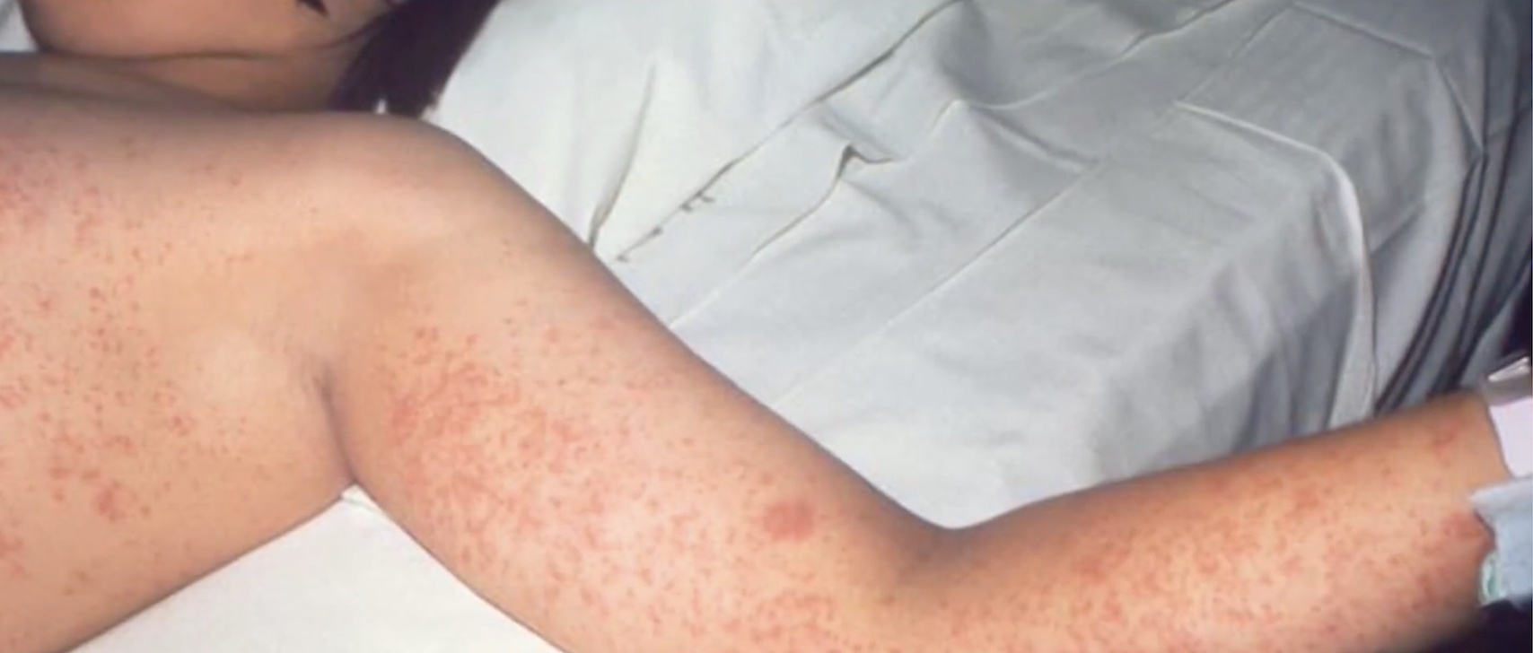 Why Barbados cannot slip on vaccines