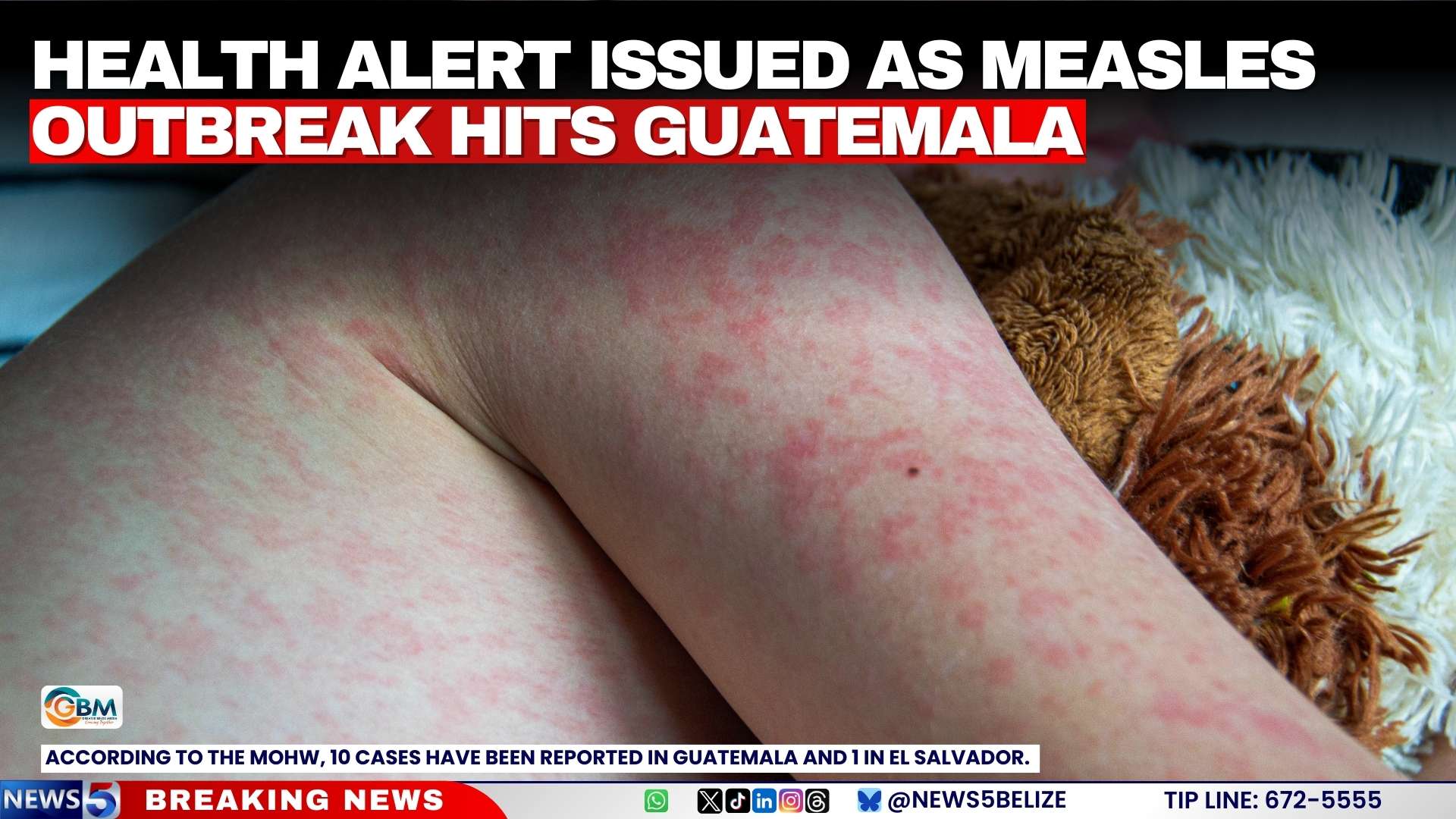 Health Alert Issued as Measles Outbreak Hits Guatemala