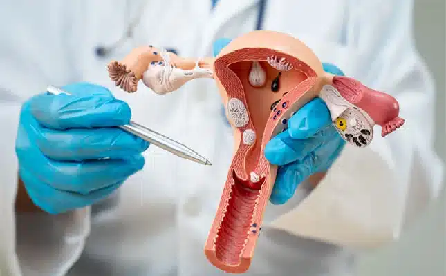 New less invasive treatments expand care options for women with endometriosis and fibroids